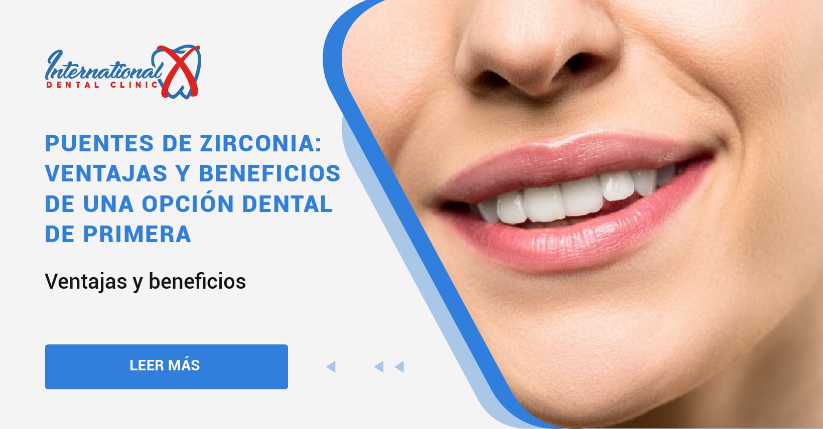 El puente de Zirconio es la mejor opción Int X Dental