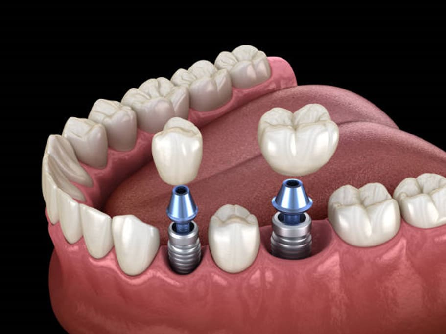 Opciones de implantes para adultos mayores