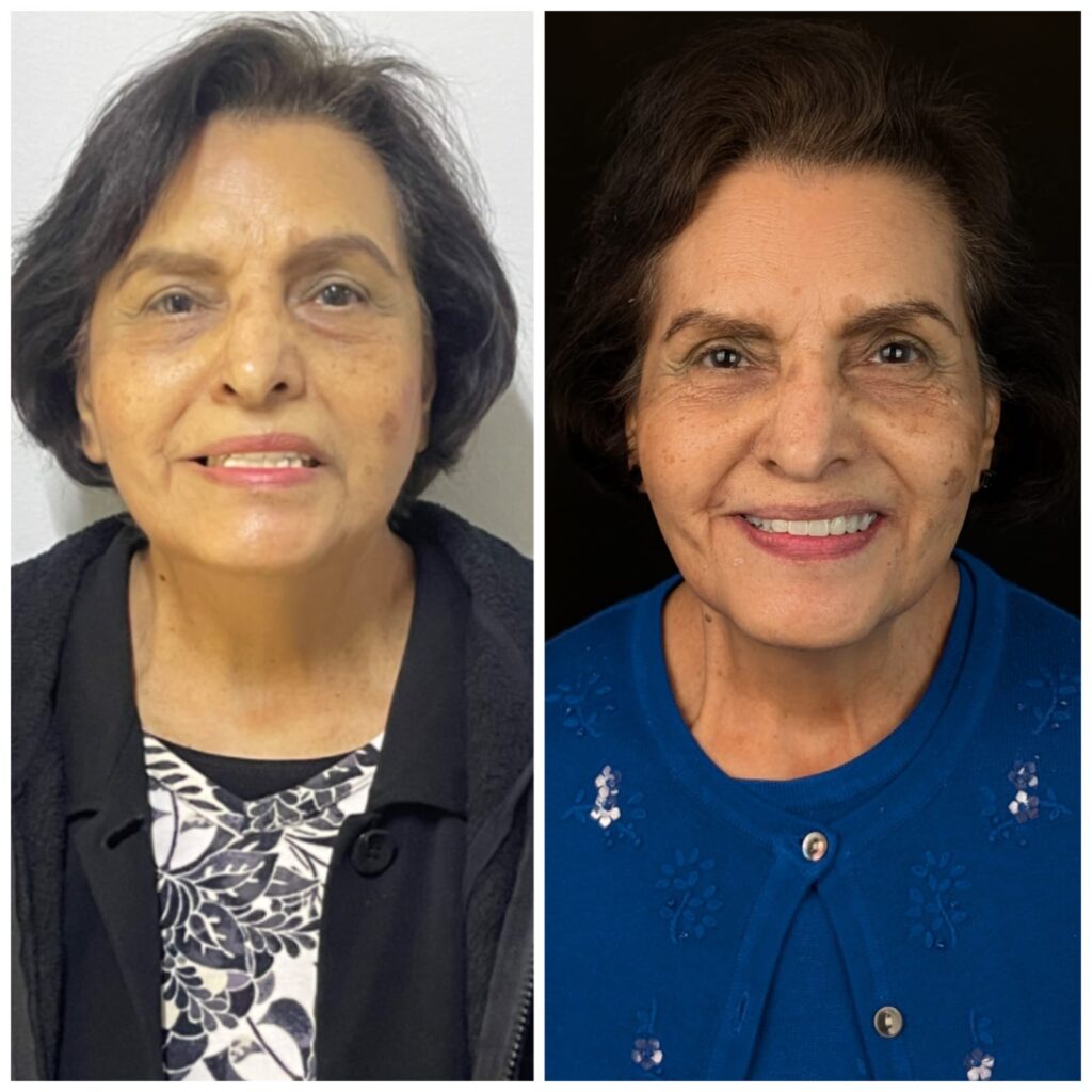 Plan de Tratamiento: Diagnóstico y Evaluación: Se realizó un diagnóstico detallado, enfocado en preservar la oclusión funcional de Jim pero modificar significativamente el área anterior de su sonrisa. Utilizamos tecnología de escaneo digital para obtener modelos precisos de su estructura dental. Tratamiento y Solución: El plan de tratamiento incluyó la restauración de la funcionalidad de mordida y la alineación de los dientes con coronas de zirconia. En su primera visita, se realizaron escaneos digitales para el diseño de coronas provisionales y, posteriormente, para las coronas permanentes. Las coronas se instalaron en solo 3 días, ofreciendo una solución estética y funcional. Tecnología Aplicada: Escaneo Digital: Para obtener imágenes tridimensionales precisas de la boca y dientes de Jim. Radiografías Avanzadas: Radiografías y tomografías 3D para una visión detallada de la salud dental de Jim. Escaneo Intraoral: Para obtener modelos digitales de los dientes y encías de Jim, usados en el diseño de las coronas. Software de Diseño Dental: Para asegurar una alineación y estética perfectas en las prótesis dentales.